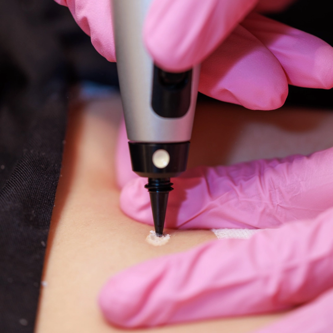 borttagning-godartad-hudforandring